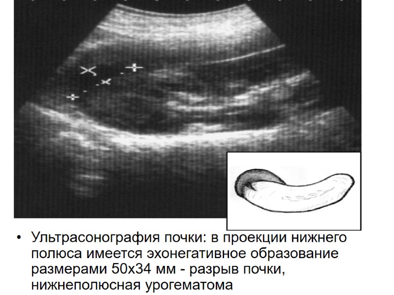 Ультрасонография почки: в проекции нижнего полюса имеется эхонегативное образование размерами 50х34 мм - разрыв